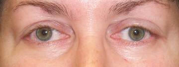 A person's eyelids before and after ptosis and blepharoplasty surgery, showing improvement in eyelid positioning and appearance.